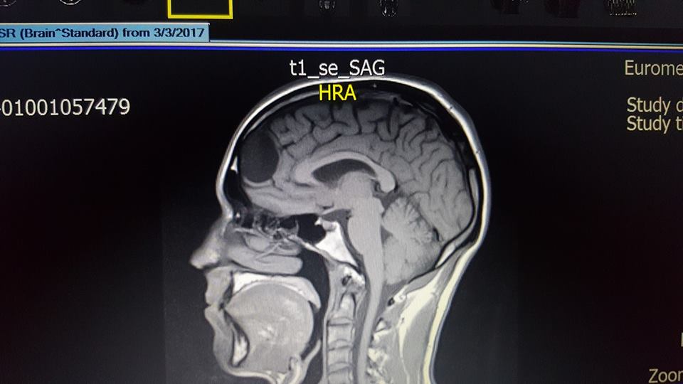 Mandatory Pre Fight Brain Scan Saves Athlete From Risk